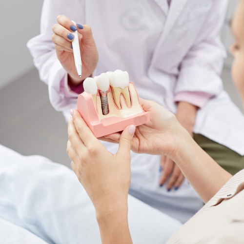 implantes dentales
