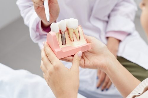 implantes dentales